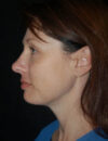 Neck Liposuction case #4986