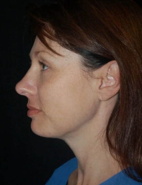 Neck Liposuction case #4986