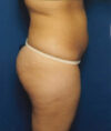 Liposuction case #4720