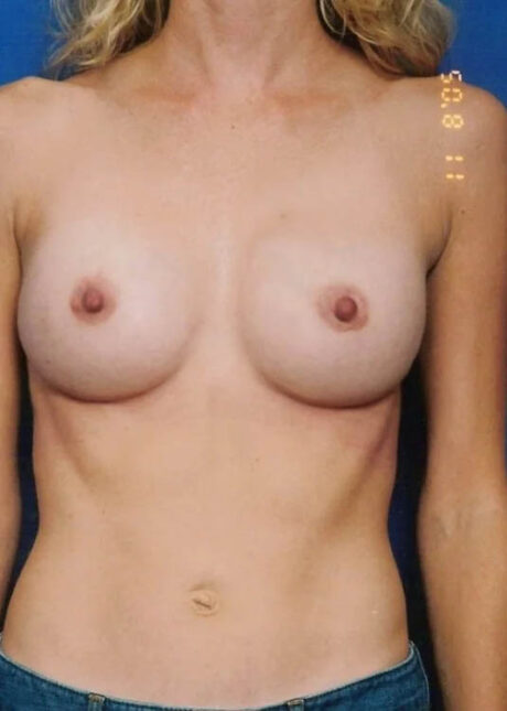 Breast Augmentation case #3680