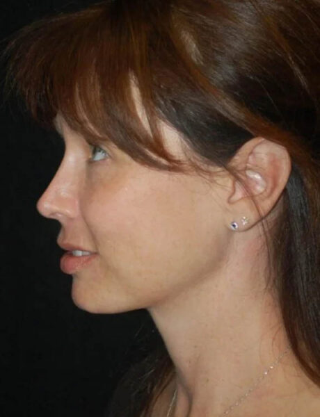 Neck Liposuction case #4986
