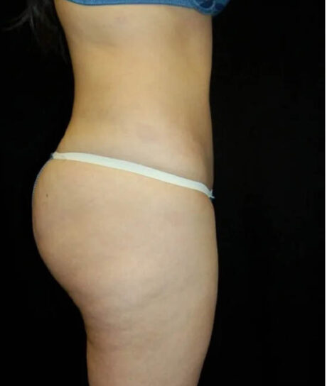 Liposuction case #4720