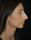 Facial Fat Grafting case #4554