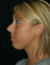 Neck Liposuction case #4989