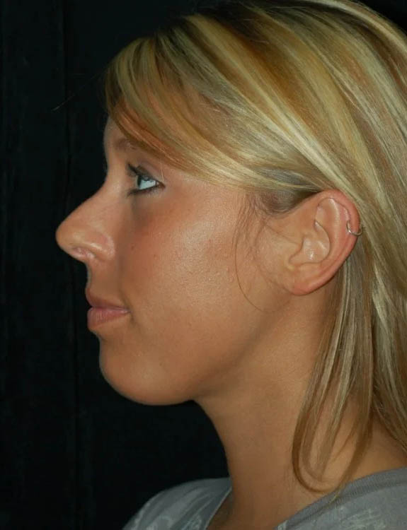 Neck Liposuction case #4989
