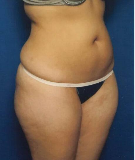 Liposuction case #4720