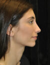 Facial Fat Grafting case #4554