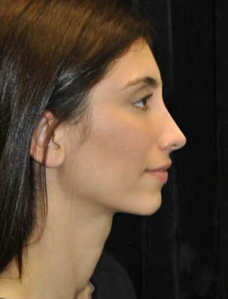 Facial Fat Grafting case #4554