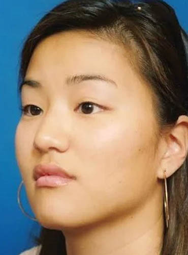 Buccal Fat Removal case #4168