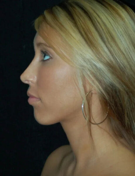 Neck Liposuction case #4989