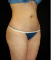 Liposuction case #4720