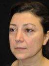 Buccal Fat Removal case #4173