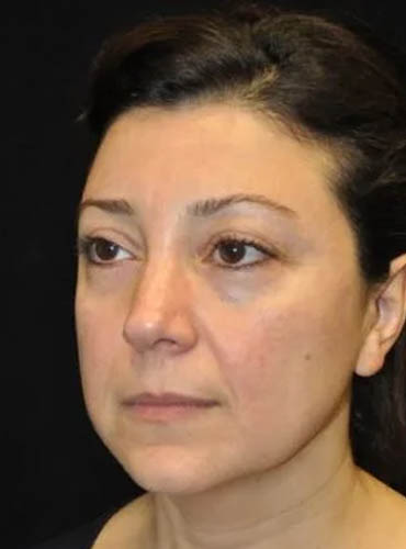 _0056_case-20-5-buccal-lipectomy-view-1-1.webp