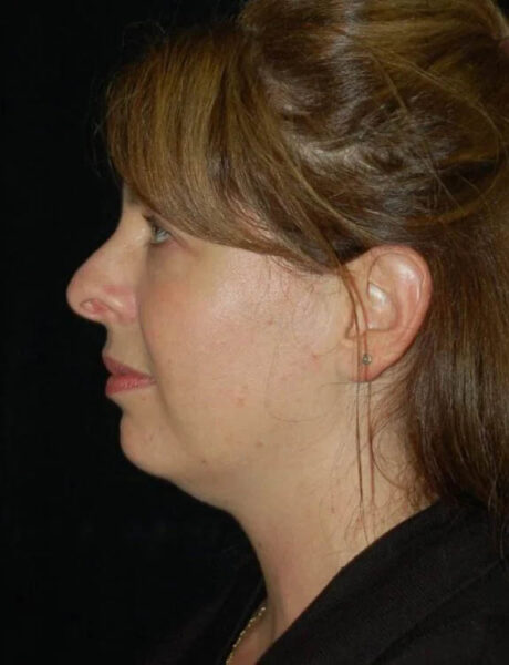 Neck Liposuction case #4992
