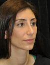Facial Fat Grafting case #4554