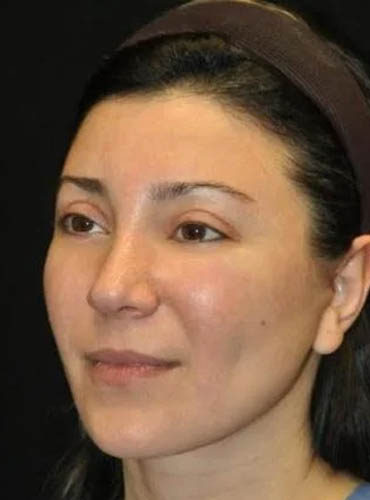 _0057_case-20-5-buccal-lipectomy-view-1-2.webp