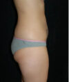 Liposuction case #4729