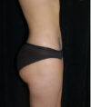 Liposuction case #4729