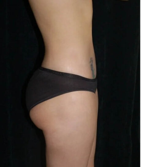 Liposuction case #4729