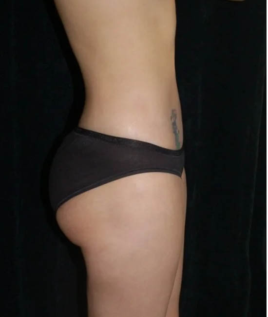 Liposuction case #4729