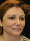 Buccal Fat Removal case #4098