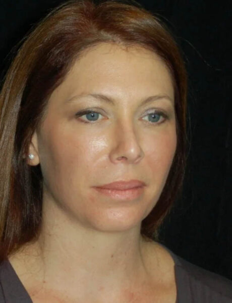 Neck Liposuction case #4992