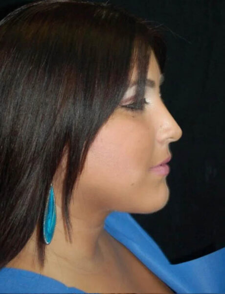 Neck Liposuction case #4997