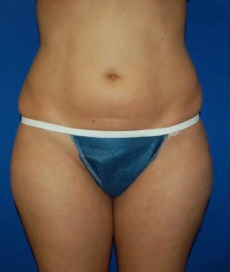 Liposuction case #4736