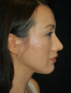 Facial Fat Grafting case #4568