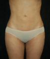 Liposuction case #4736