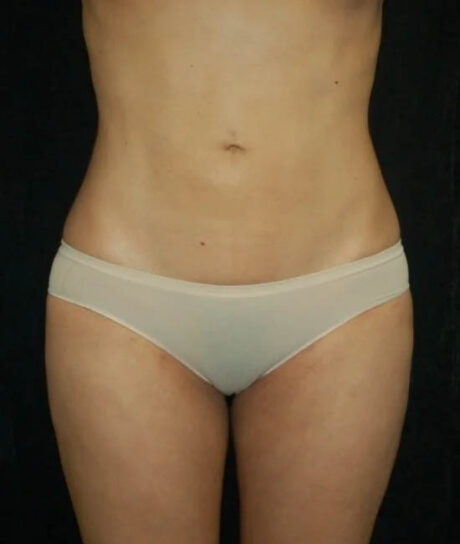 Liposuction case #4736