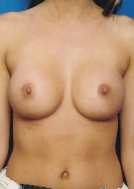 Breast Augmentation case #3692