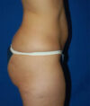 Liposuction case #4736
