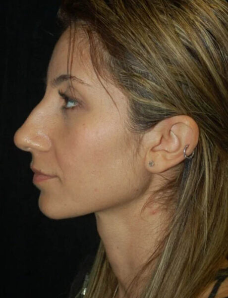 Facial Fat Grafting case #4571