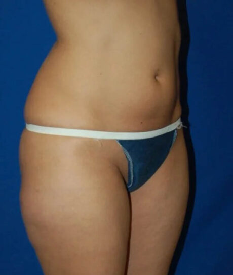 Liposuction case #4736