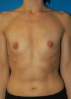 Breast Augmentation case #3697