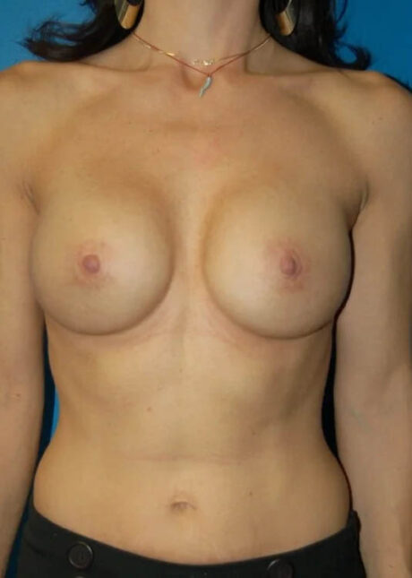 Breast Augmentation case #3697