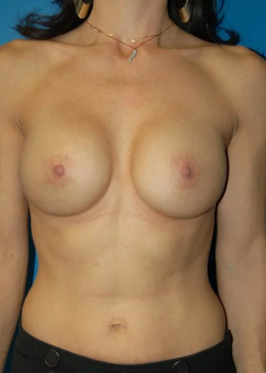 Breast Augmentation case #3697