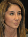 Facial Fat Grafting case #4571
