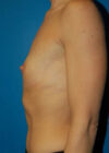 Breast Augmentation case #3697