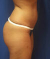 Liposuction case #4743