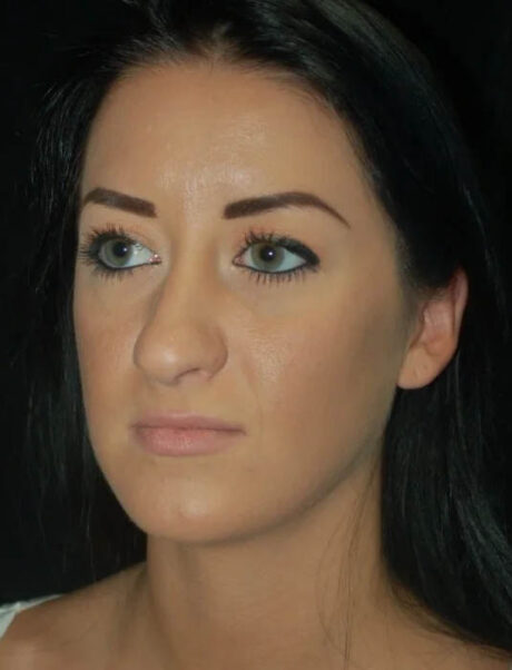 Facial Fat Grafting case #4576