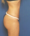 Liposuction case #4743