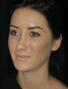 Facial Fat Grafting case #4576