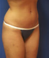 Liposuction case #4743