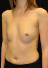 Breast Augmentation case #3702
