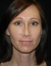 Facial Fat Grafting case #4581
