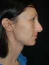 Facial Fat Grafting case #4581