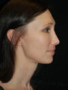 Facial Fat Grafting case #4581