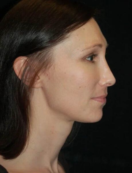Facial Fat Grafting case #4581